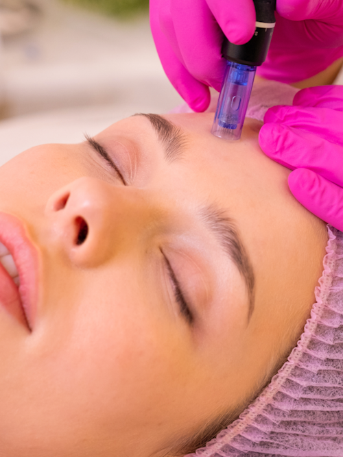 Micro Needling, Dr. Christian Fellenz, Hautarzt in Wien